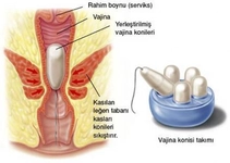 Pelvis Kası Güçlendirme Yöntemleri Pelvis Kası Güçlendirme Yöntemleri