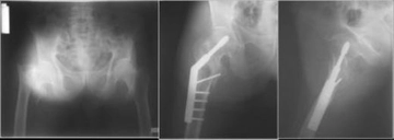 Pelvis Kırığı Ameliyatı Riskleri ve Sonrası Pelvis Kırığı Ameliyatı Riskleri ve Sonrası