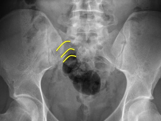 Pelvis Grafisi Özellikleri